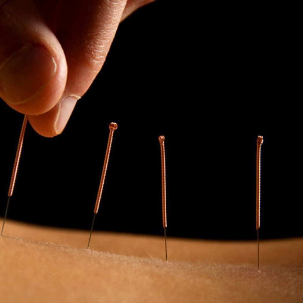 Acupuncture to Induce Labor Exploring the Science, Safety, and Success