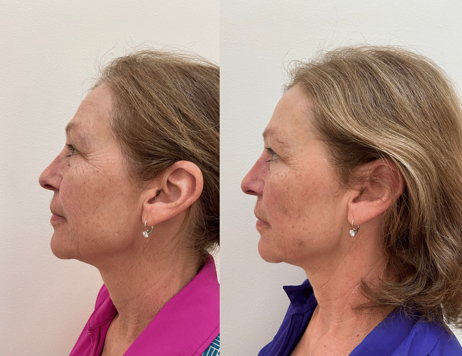 Before and after transformation of a person\'s face following facial acupuncture treatment