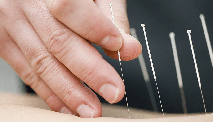 is-acupuncture-covered-by-insurance-a-comprehensive-guide