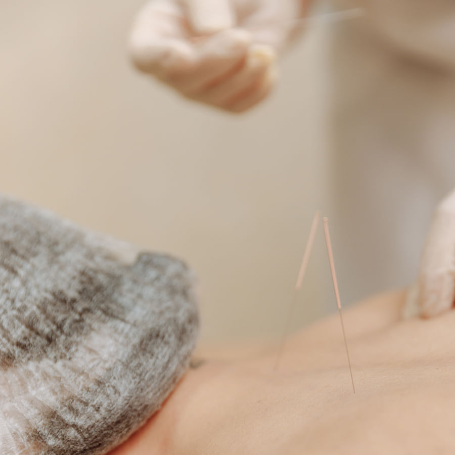 Person undergoing acupuncture therapy for detoxification