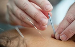 Can acupuncture be used to relieve nausea?
