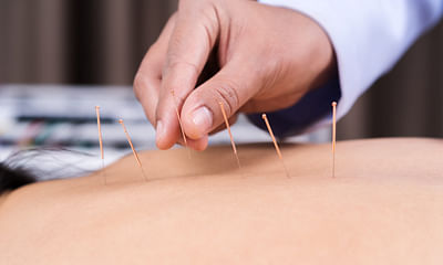What are the benefits of acupuncture and how often should I receive treatment?