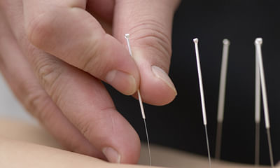 What is acupuncture therapy?